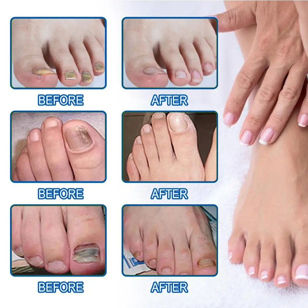 HealthyNail™ náplasti na obnovu plesňových nechtov - Diskrétne obnovte čisté, zdravé nechty